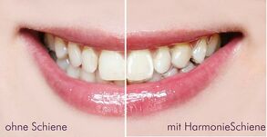 Mit und ohne Harmonieschiene Mit und ohne Harmonieschiene